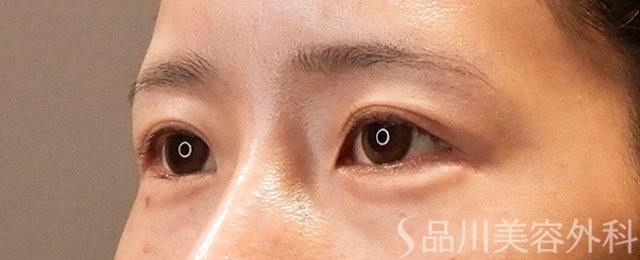 症例NO.70551のAFTER写真