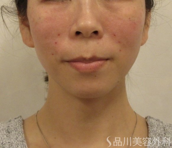 症例NO.73554のAFTER写真