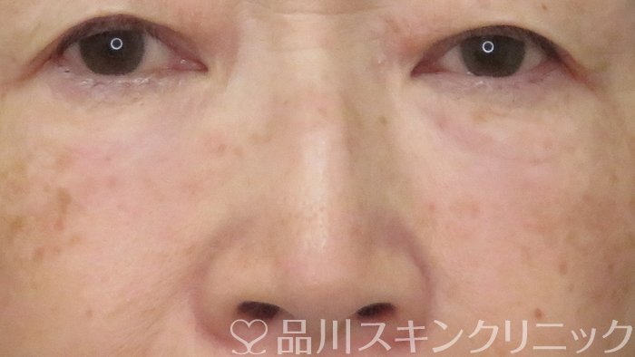 症例NO.71558のAFTER写真
