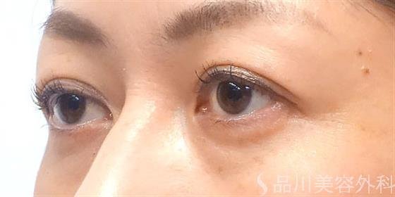 症例NO.20836のAFTER写真