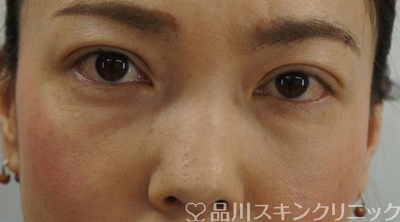 症例NO.43343のAFTER写真