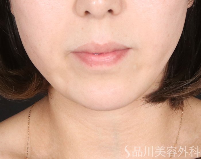 症例NO.73316のAFTER写真