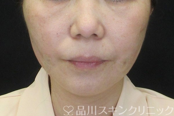 症例NO.65514のAFTER写真