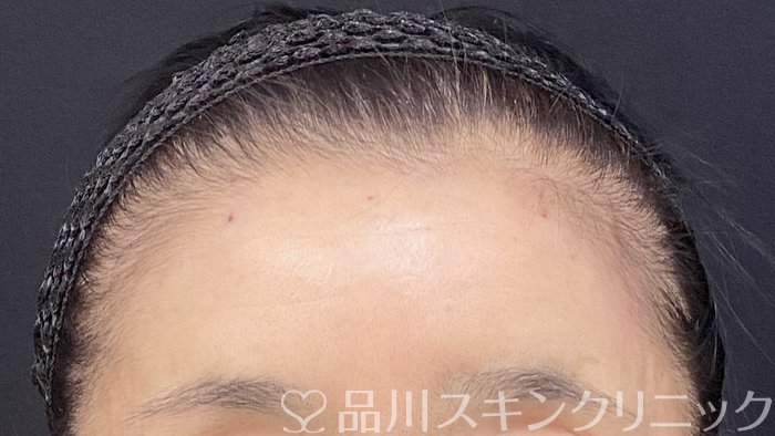 症例NO.74401のAFTER写真