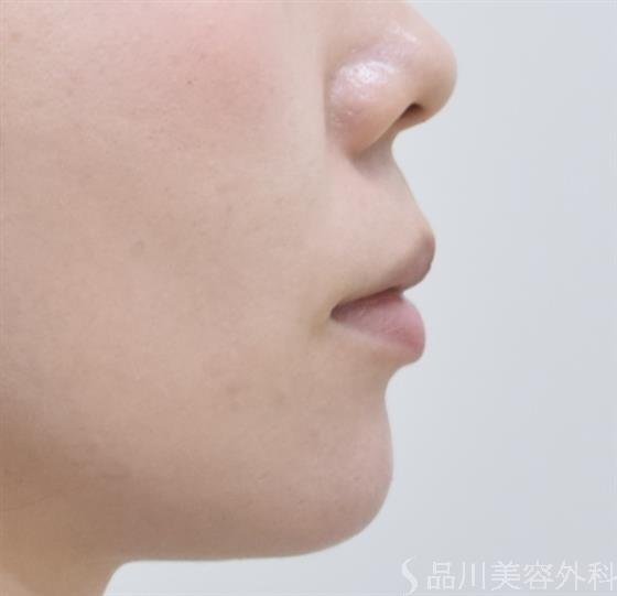 症例NO.44114のAFTER写真