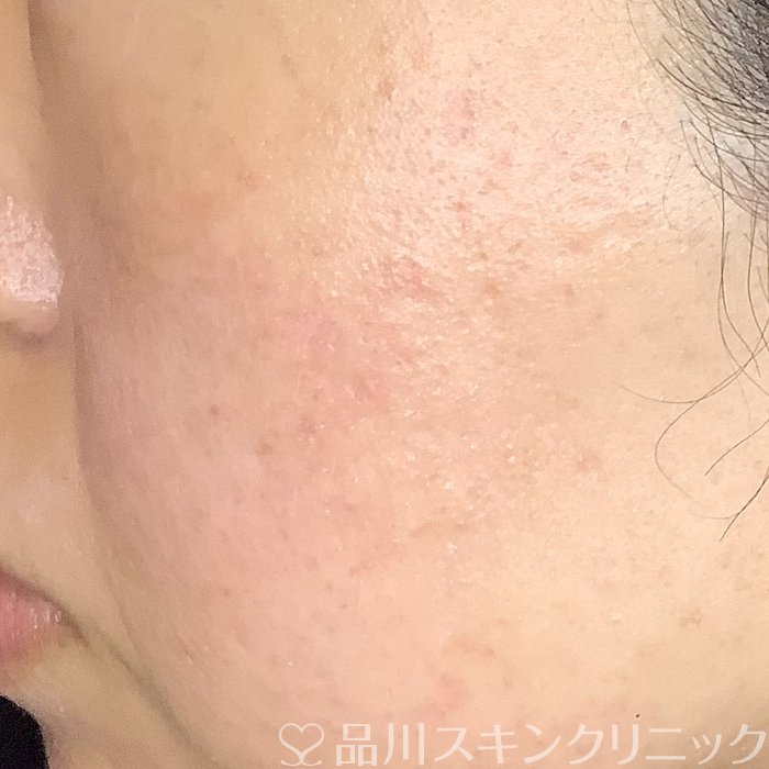 症例NO.65631のAFTER写真
