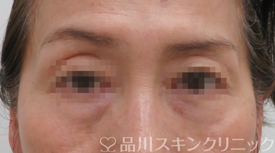症例NO.71164のBEFORE写真