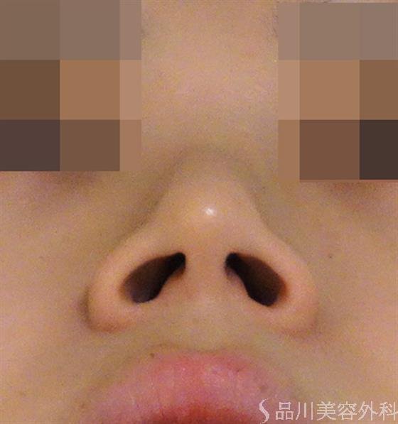 症例NO.44654のAFTER写真