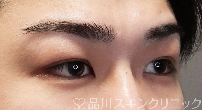 症例NO.70244のBEFORE写真