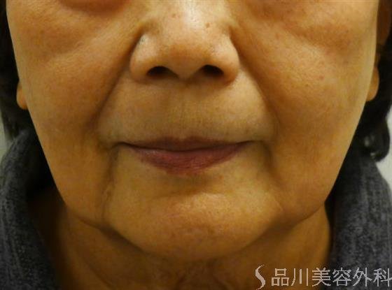 症例NO.33756のBEFORE写真