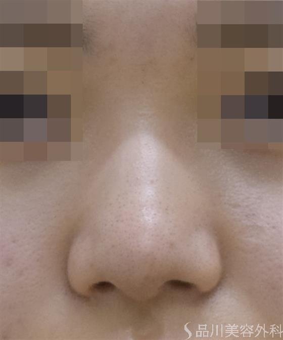 症例NO.47154のAFTER写真