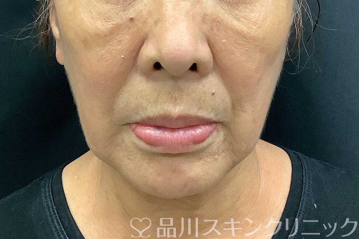 症例NO.69776のBEFORE写真