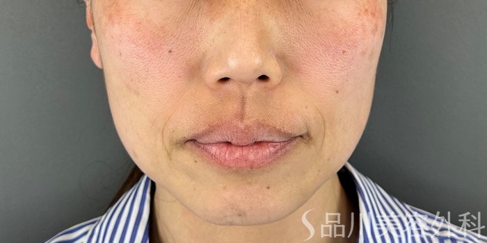 症例NO.70809のBEFORE写真