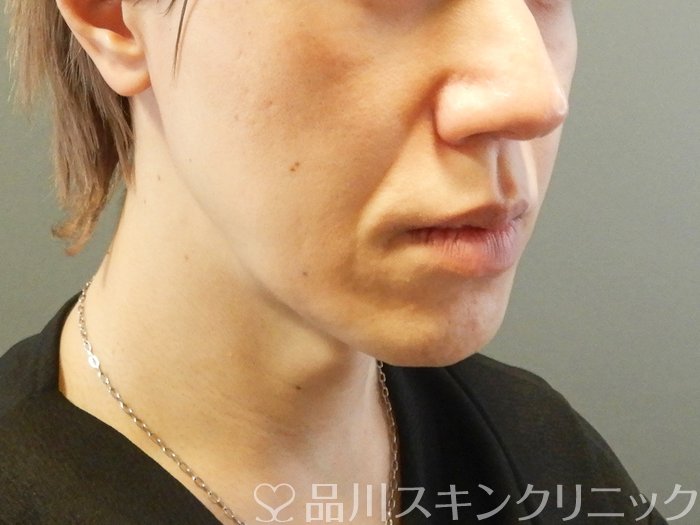 症例NO.63154のBEFORE写真