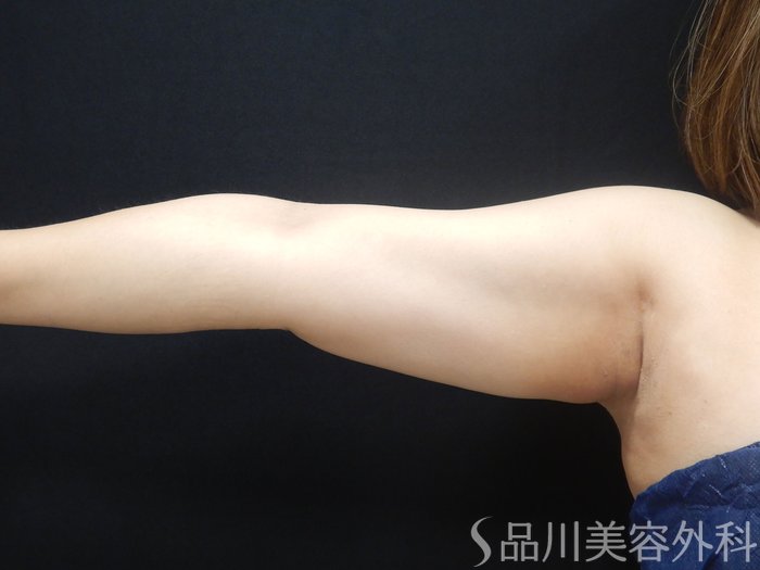 症例NO.70469のAFTER写真