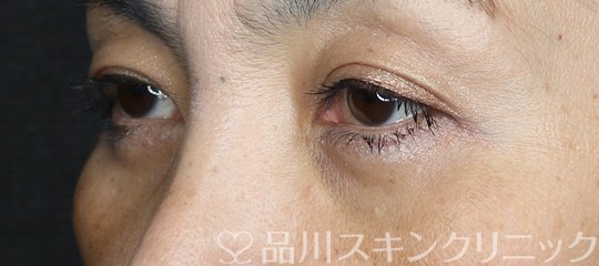 症例NO.70678のAFTER写真