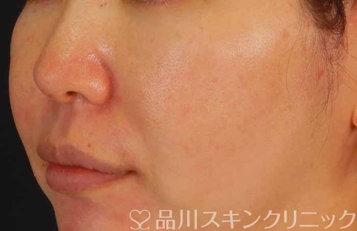 症例NO.66481のAFTER写真