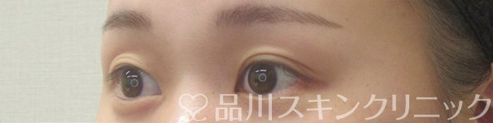 症例NO.73938のBEFORE写真