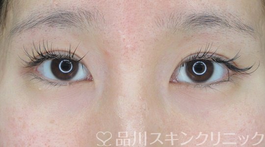 症例NO.71391のBEFORE写真