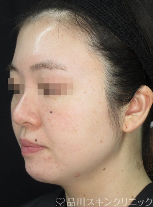 症例NO.72175のBEFORE写真