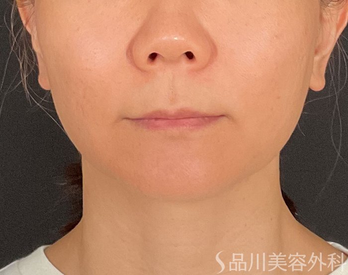 症例NO.74729のBEFORE写真
