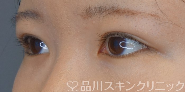 症例NO.71543のAFTER写真