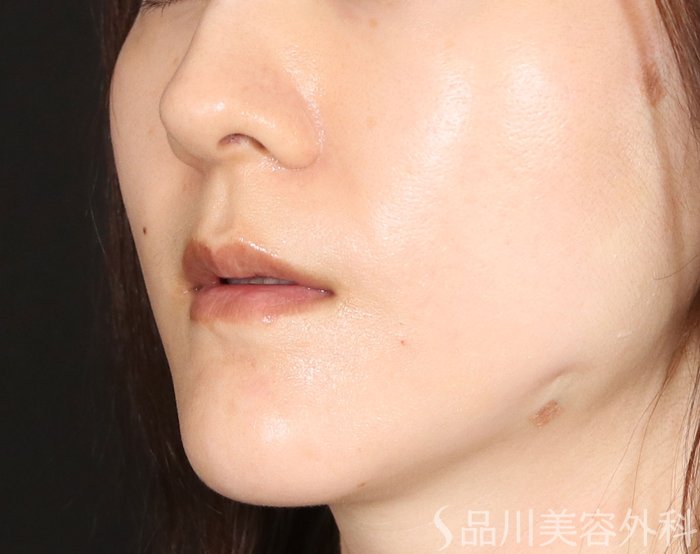 症例NO.71748のAFTER写真