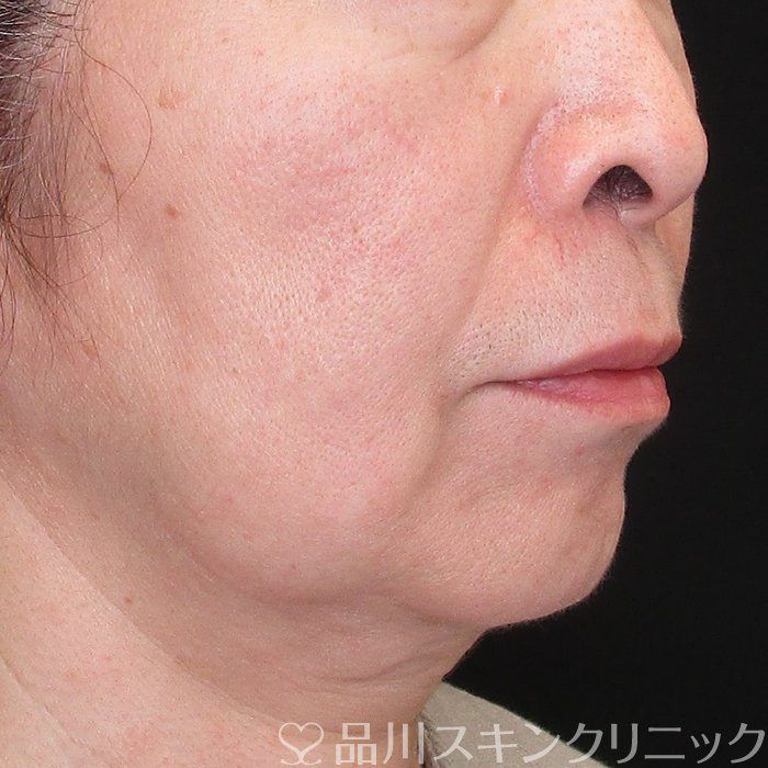 症例NO.74209のBEFORE写真