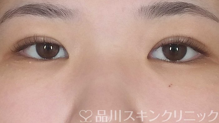 症例NO.71942のAFTER写真