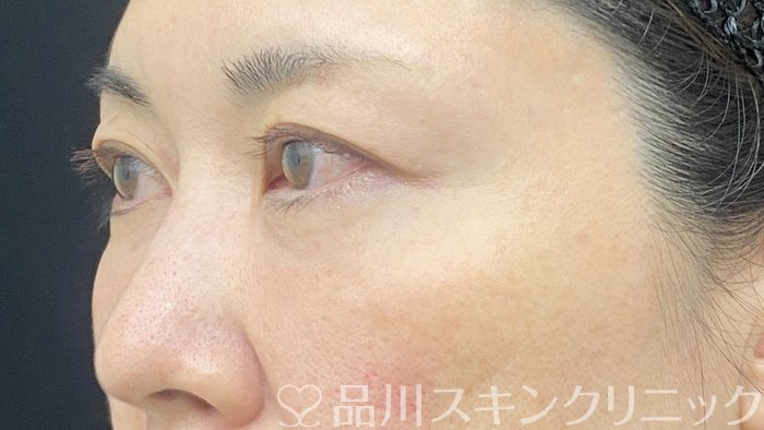 症例NO.74278のAFTER写真