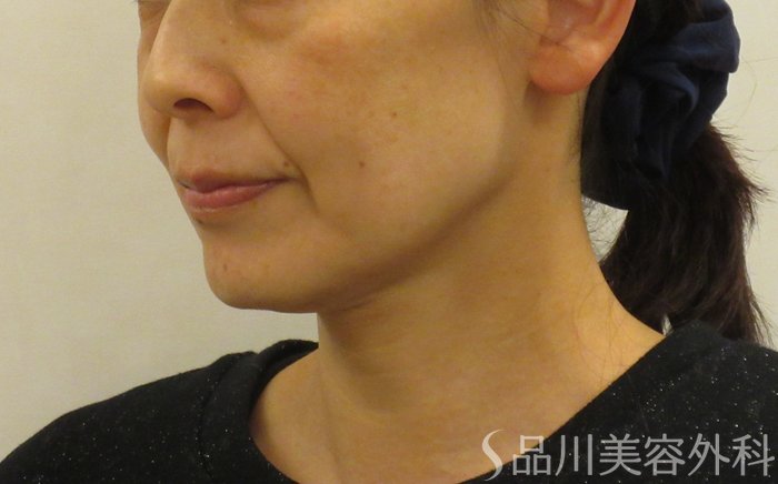 症例NO.72870のBEFORE写真