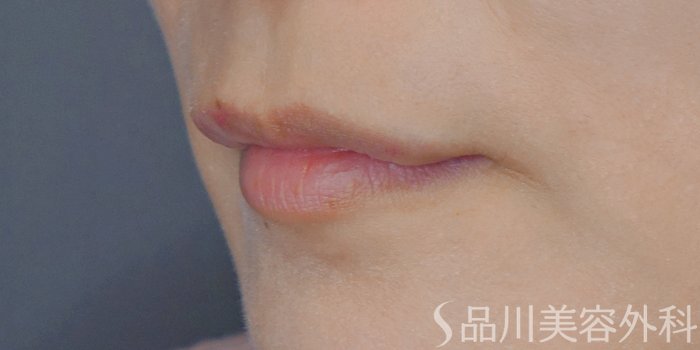 症例NO.72139のBEFORE写真