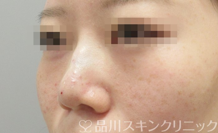 症例NO.71045のAFTER写真