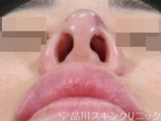 症例NO.73206のAFTER写真