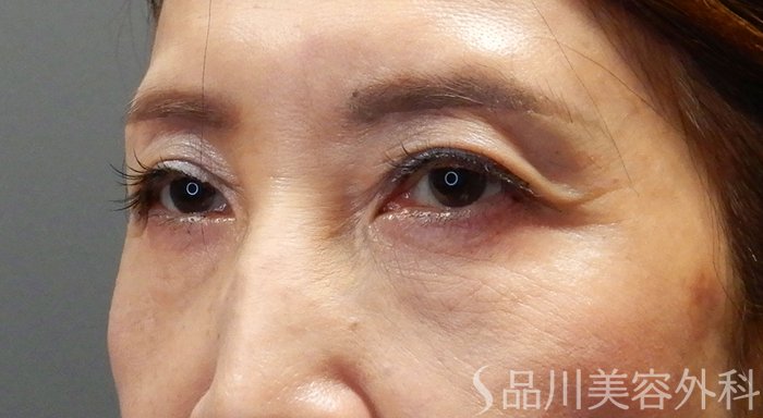 症例NO.71187のAFTER写真