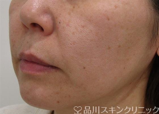 症例NO.41629のAFTER写真