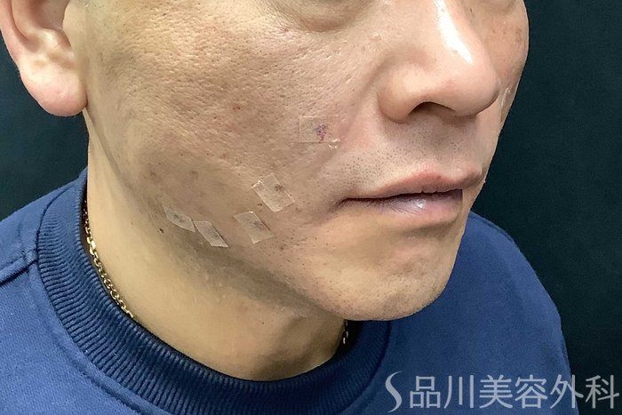 症例NO.69615のAFTER写真