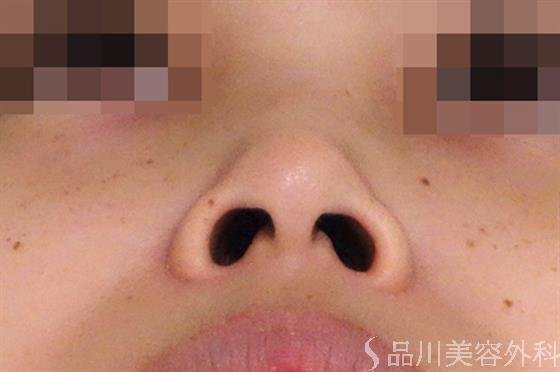 症例NO.38169のBEFORE写真