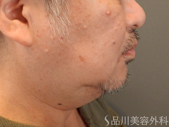 症例NO.67662のBEFORE写真