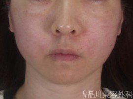 症例NO.73776のAFTER写真