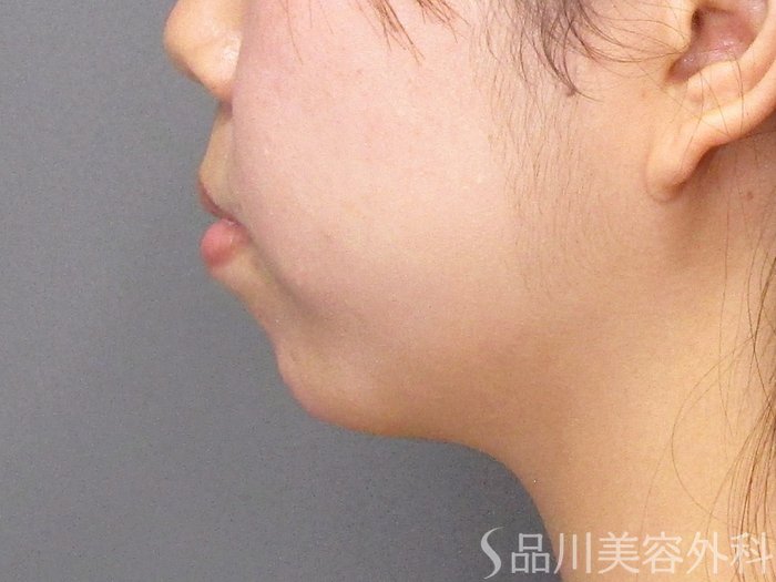 症例NO.75059のAFTER写真