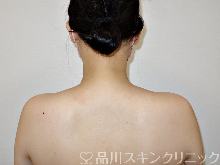 症例NO.73258のBEFORE写真