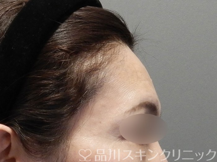 症例NO.74757のBEFORE写真