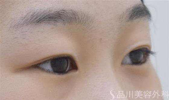症例NO.52259のBEFORE写真