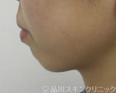症例NO.64986のBEFORE写真
