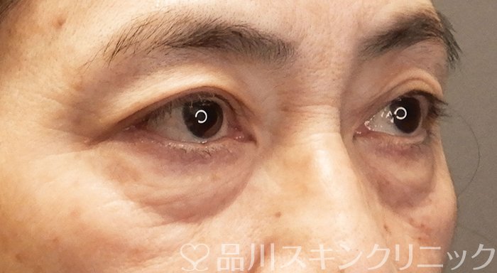 症例NO.70629のBEFORE写真