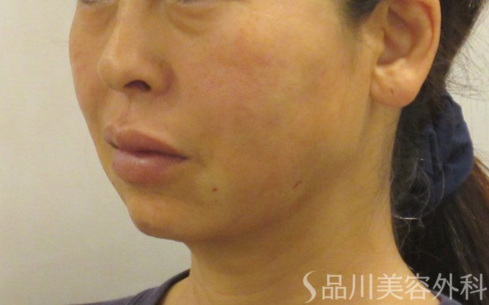 症例NO.71805のAFTER写真