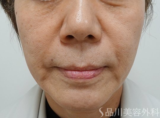 症例NO.71758のBEFORE写真