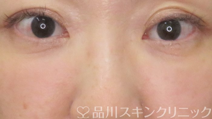 症例NO.71451のAFTER写真
