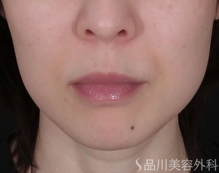 症例NO.69720のBEFORE写真
